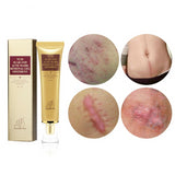 ACNE SCAR REMOVAL CREAM